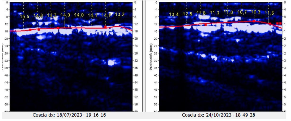 Follow up tessuto adiposo coscia